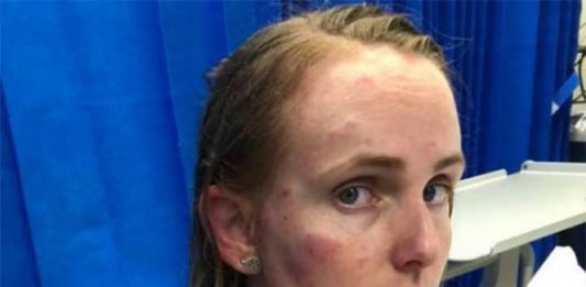 Mujer sufre graves lesiones por proteger a su bebé de granizo