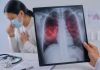 La tuberculosis es curable si se detecta y trata oportunamente