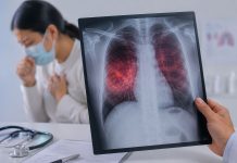 La tuberculosis es curable si se detecta y trata oportunamente